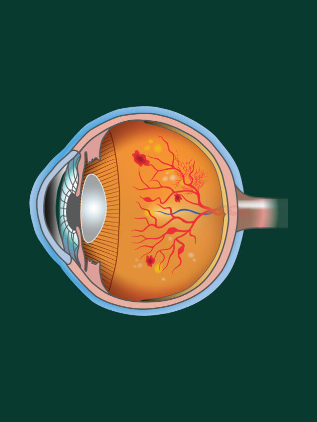 Diabetic retinopathy